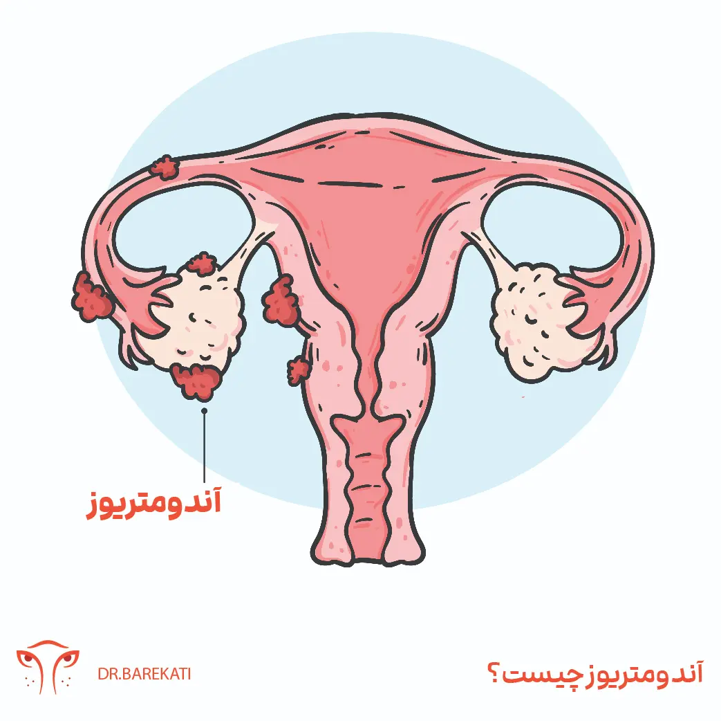 اندومتریوز چیست؟