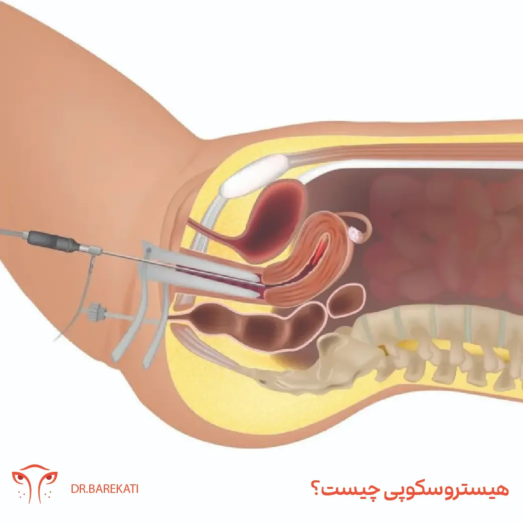 عمل هیستروسکوپی چیست؟