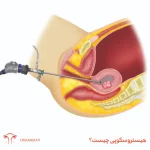 هیستروسکوپی چیست؟