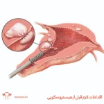 اقدامات لازم قبل از هیستروسکوپی