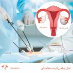 عمل جراحی کیست تخمدان