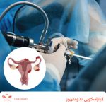 لاپاراسکوپی آندومتریوز