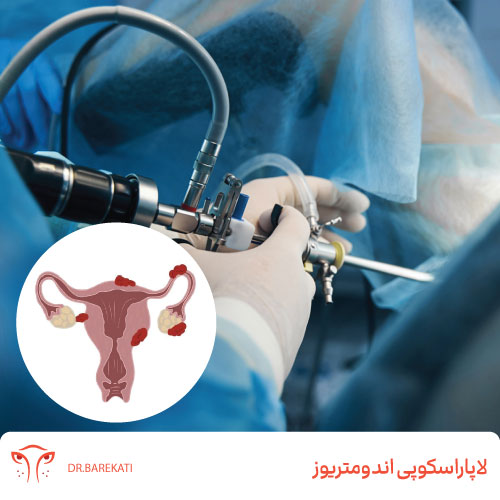 لاپاراسکوپی اندومتریوز