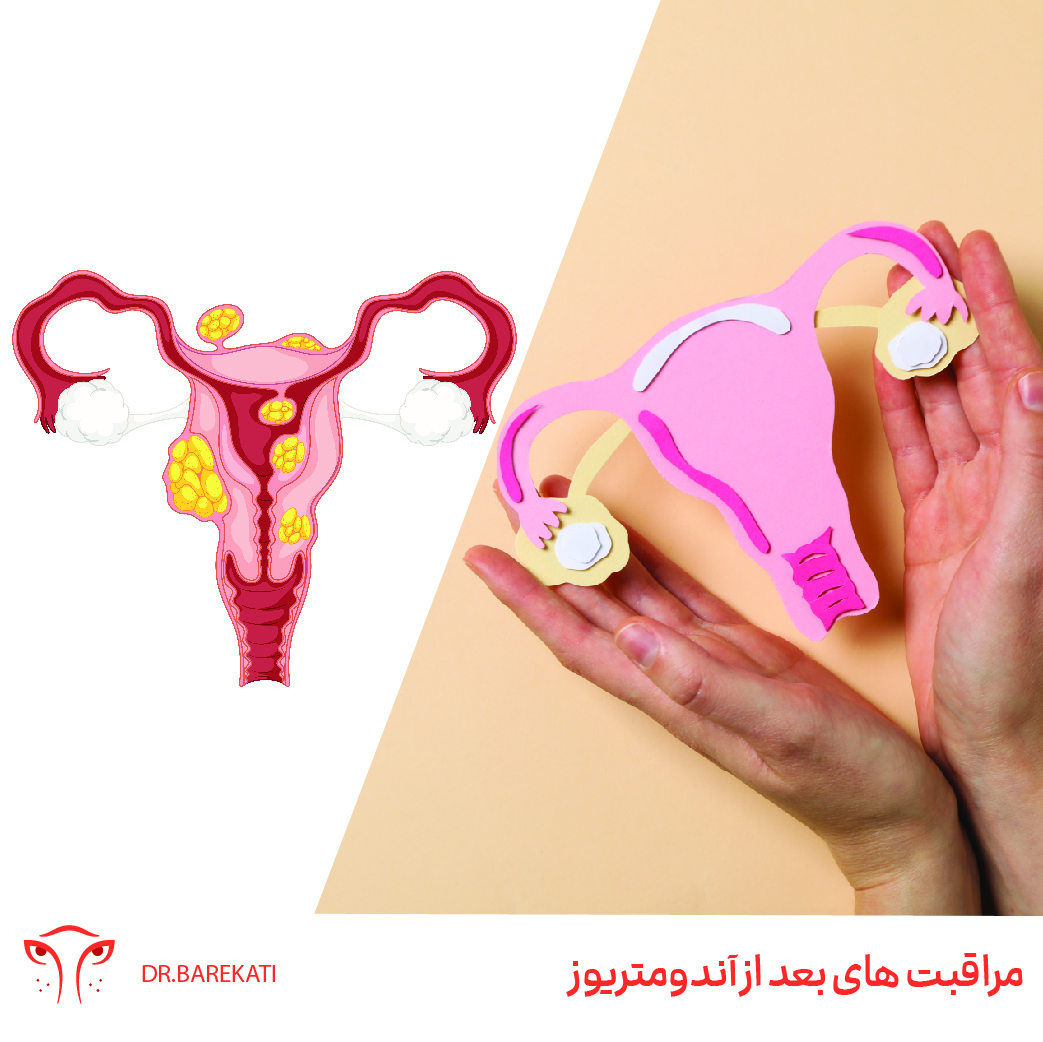 مراقبت های بعد از عمل لاپاراسکوپی اندومتریوز