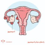 درمان آندومتریوز