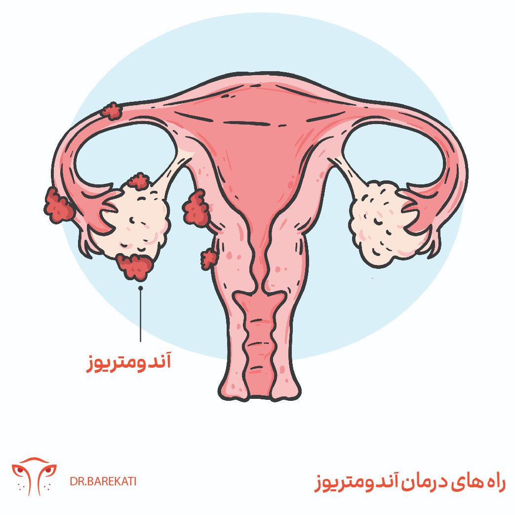 راه های درمان آندومتریوز از زبان دکتر برکتی