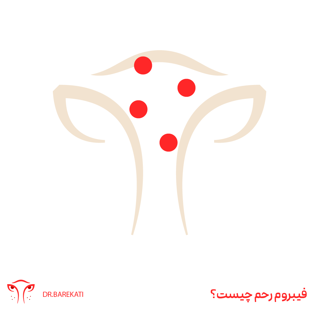 فیبروم رحم از زبان دکتر برکتی